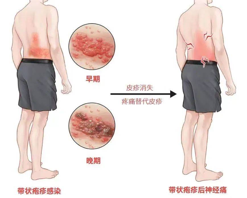 一旦感染终身携带<strong></p>
<p>集合理财</strong>！深圳疾控提醒：这4类人要注意