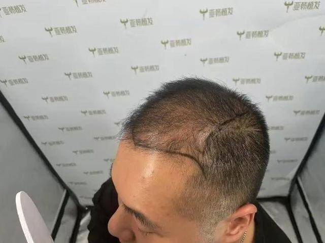 “还能反光<strong></p>
<p>多盈理财</strong>！”长沙男子植发近9月称后脑勺“像狗啃过”