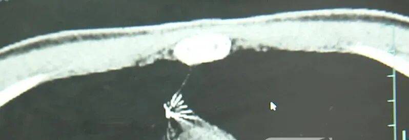 17岁小伙参军体检发现胸腔内有根5cm缝衣针<strong></p>
<p>虚拟币ACN是什么</strong>，父母回忆或是1岁时扎入，取出时已锈迹斑斑